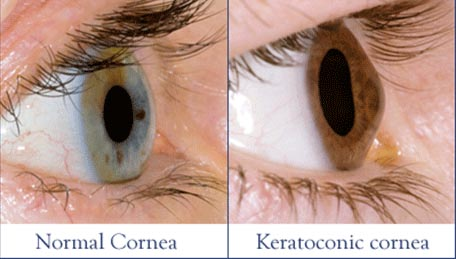 Corneal Collagen Crosslinking